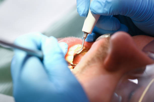Best Emergency Dentist for Lost Fillings or Crowns in Mullens, WV
