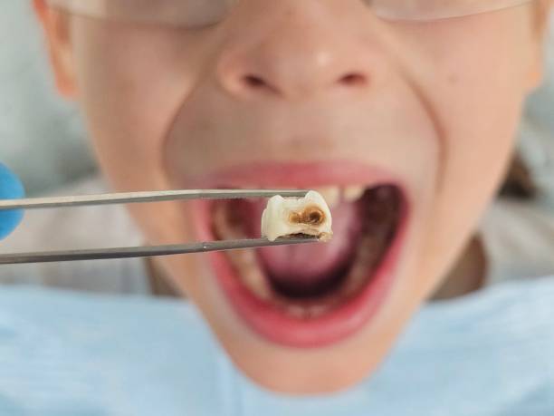 Best Emergency Dental Extractions in Mullens, WV
